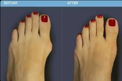 longeta-za-ispravljanje-cukljeva-okshop-2.png Longeta za ispravljanje čukljeva | Korekcija Hallux Valgus